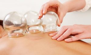 cupping